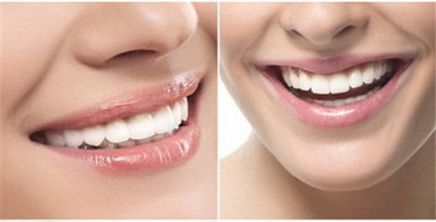 矫正牙齿时的饮食注意事项_在什么年龄矫正牙齿最有效?
