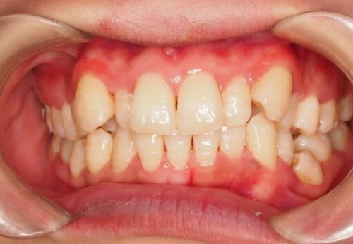 隐形牙套有一颗牙不贴合「隐形牙套一颗牙不贴合」