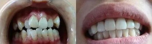 牙齿内部发黄,周围透明_牙齿磨损后敏感怎么办