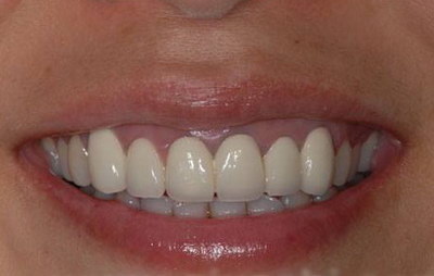 牙齿是怎样种植的_牙齿常缺什么原因