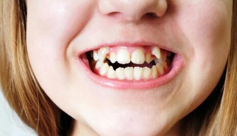 牙周炎刮治后牙龈萎缩