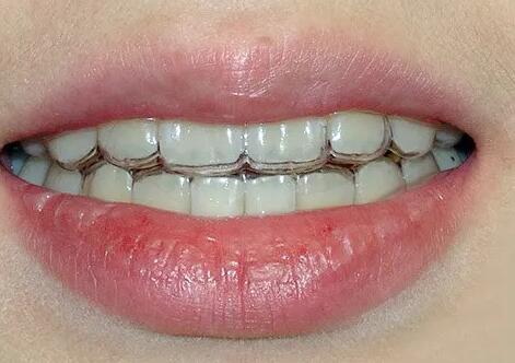 牙龈有白色的凸起_牙龈出血怎么医治