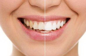 门牙拔牙后多久能种植牙齿