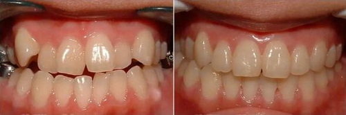 烤瓷牙治疗过程_烤瓷牙治疗周期