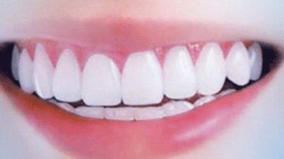 种植牙的好处及护理方法_适合18岁以上做种植牙的文章