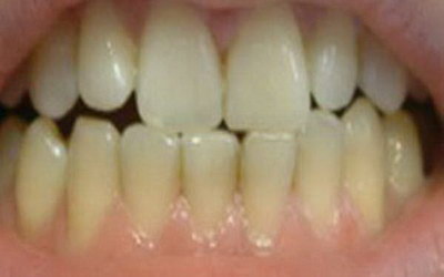 人正常牙齿有多少颗牙(成人正常牙齿的数量)