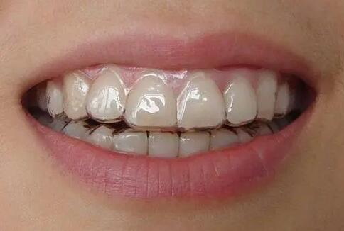 拔完牙就可以种牙吗_拔完牙的牙洞会愈合吗