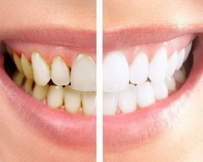 多久洗一次牙齿比较健康(为什么需要刷牙？)