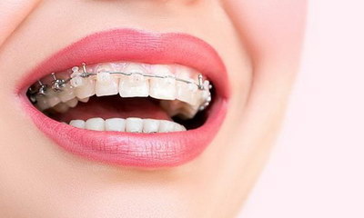 拔牙多久后可以开始矫正(牙齿拔牙后需要恢复多久才能开始矫正？)