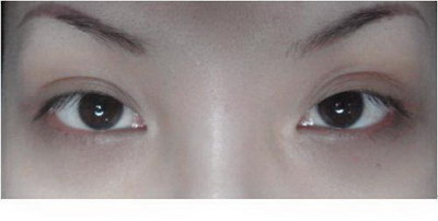 韩式三点双眼皮手术多少钱?
