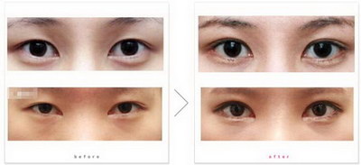 术后双眼皮恢复过程图_双眼皮手术恢复期能看手机吗?