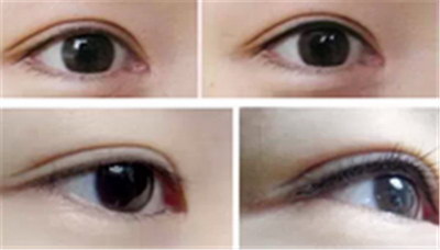 怎么可以让近视眼的人恢复视力_广州近视眼手术排名