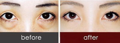 眼角白色分泌物是什么原因(眼角白色分泌物的原因)