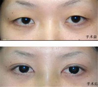 眼睛凹陷是什么原因怎么恢复_眼睛周围能打玻尿酸吗