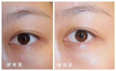 双眼皮6毫米恢复了有多窄_双眼皮为什么恢复的不一样