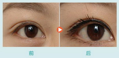做了双眼皮一般多久恢复正常(做了双眼皮需要多长时间恢复正常？)