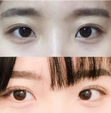 韩式双眼皮效果怎样？