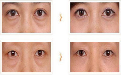大眼睛双眼皮术后应该怎么吃？
