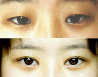 怎么锻炼眼皮肌肉有力_成都韩式无痕双眼皮