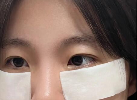 韩式定位双眼皮需要拆线吗(数码定位双眼皮需要拆线吗)