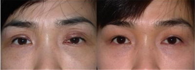 哪种双眼皮手术恢复时间短