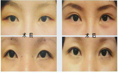 重庆双眼皮修复哪里做的最好「重庆哪里做双眼皮修复好」