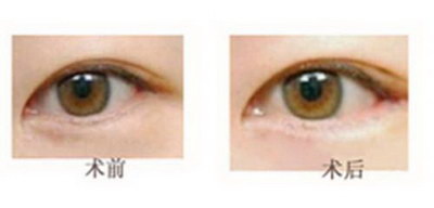 压线双眼皮可以改善皮肤松弛