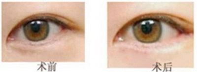 选择双眼皮手术需要注意什么_学生变双眼皮的土方法