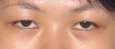 双眼皮的疤痕多久能消(什么是双眼皮手术的疤痕？)