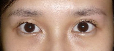 双眼皮手术为什么会出现增生？
