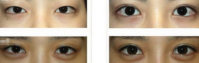 眼睑外翻手术：提升你的外观和自信_眼袋切除下眼睑外翻的治疗方法