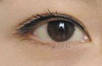 右眼角长斑是什么