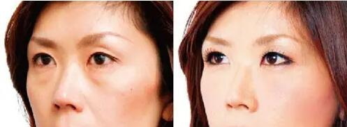 贴双眼皮的危害_纳米无痕双眼皮修复:能够以最自然的方式实现双眼皮修复