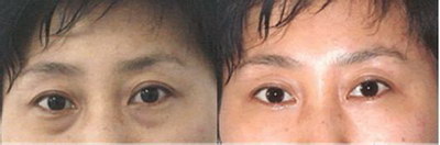 最好的眼袋手术方法：从前瞻性的技术到有效的护理