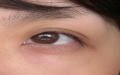 眼膜脱落是怎么治疗_眼膜松弛是什么引起的