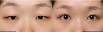 注射眼部除皱针到底有什么副作用？