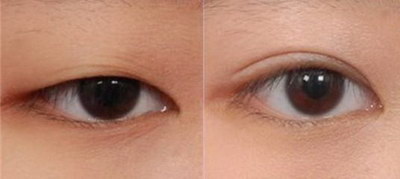 双眼皮是显性基因还是阴影基因(什么是显性和隐性基因)