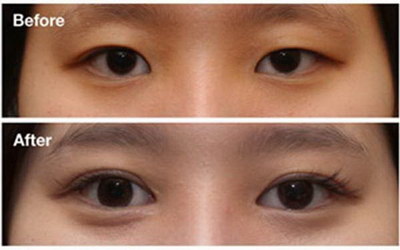 双眼皮手术后遗症:直观外表的代价(做双眼皮手术有什么后遗症吗)