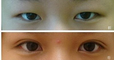 眼袋修复手术效果怎么样_眼袋修复术与眼袋祛除术的区别