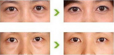 黑眼圈是什么原因引起的眼袋_黑眼圈和眼袋可以做手术去除吗