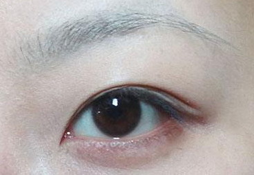 韩式平行双眼皮恢复图