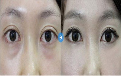 人眼皮褶袢在现代生活中的作用_割完双眼皮手术后能吃花生吗