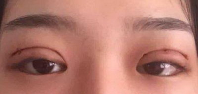 韩式双眼皮的术前要注意哪些