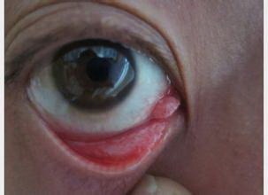 双眼皮术后两个眼睛肿胀不一样(双眼皮术后两个月眼睛还是肿的怎么办)