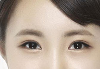纳米无痕双眼皮恢复期是多少天_纳米无痕双眼皮恢复期是多久