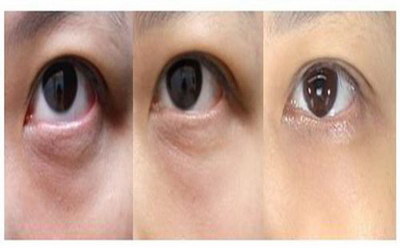 双眼皮手术恢复期需要多久