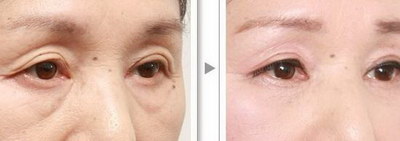 双眼皮手术多久可以消除淤青_双眼皮手术做第几台好