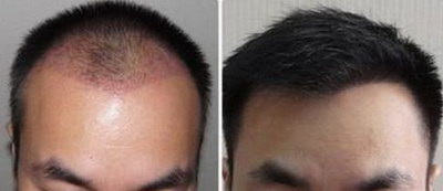 种植发际线多久能长起来(种植发际线后多久能长出新发？)
