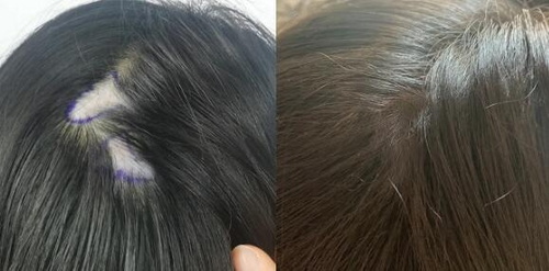 北京种植头发大概是哪些过程_雍禾种植头发成活率低