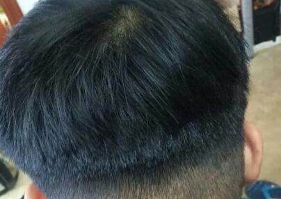 改善头发毛躁：5个简单而有效的方法_植发2：恢复头顶头发稀少的有效方式